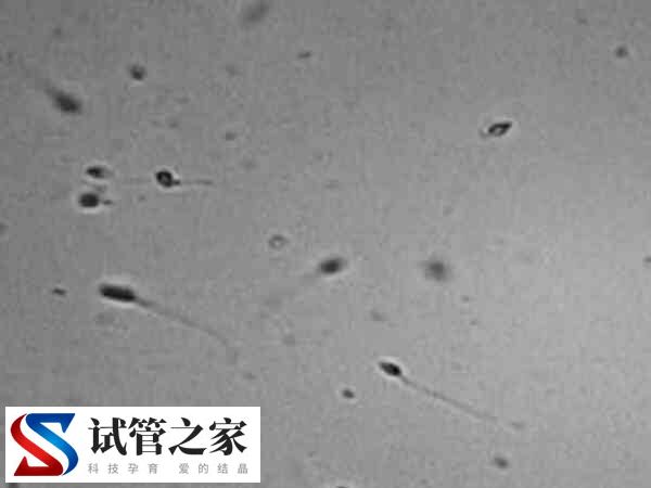 死精症需要做哪些检查(图1)
