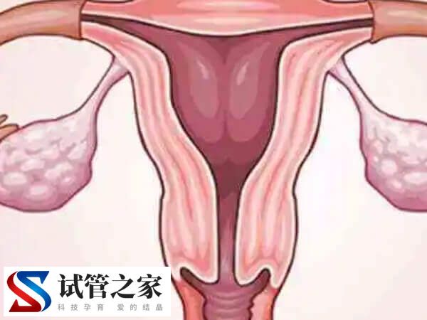 为什么会有巧克力囊肿(图1)
