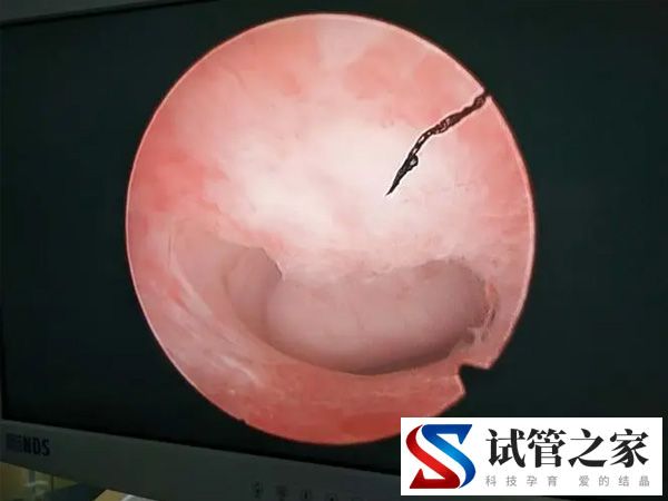 黄促方案什么时候移植(图2)