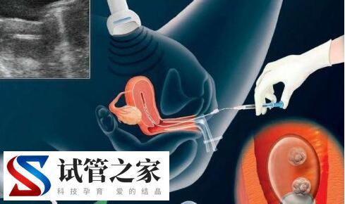 国内医院做试管婴儿的条件有哪些(图1)