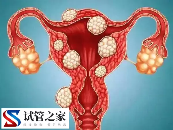 宫腔粘连能否做试管婴儿(图1)