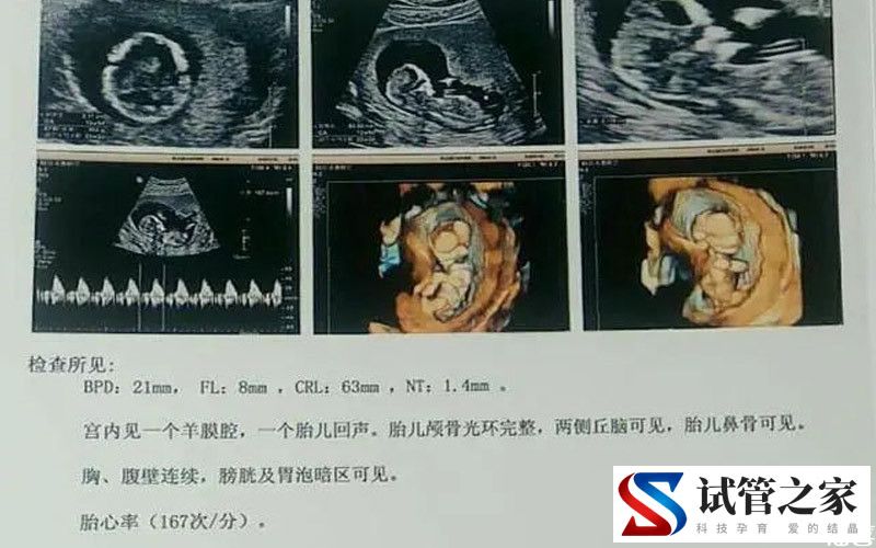 孕期nt检查正常参考值揭秘,准妈数值偏高不可掉以轻心(图2) 孕期nt检查正常参考值揭秘,准妈数值偏高不可掉以轻心(图2)