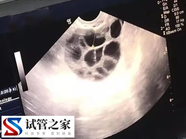 打破卵针隔天卵泡变小怎么回事(图2)