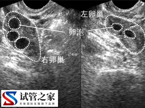 B超监测卵泡要注意什么(图1)