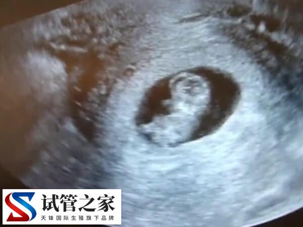 试管婴儿移植后为什么需要做B超(图1) 试管婴儿移植后为什么需要做B超(图1)