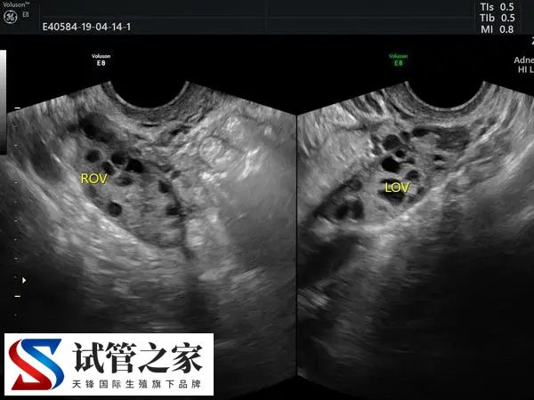 卵泡超过25mm能不能怀孕