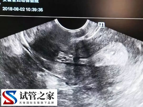 试管能不能移植鲜胚(图2)