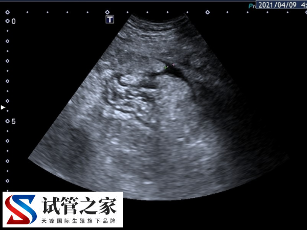 前往泰国做试管婴儿取卵是怎么取的(图1)