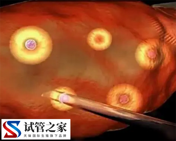 试管取卵和胚胎培养哪个好(图1)