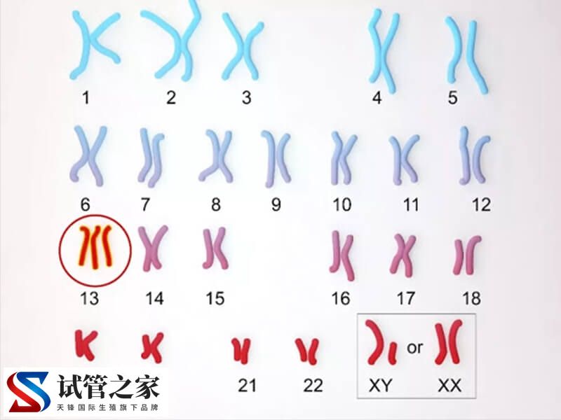 唐氏综合征21号异常染色体引发的危害(图1)