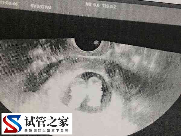 试管婴儿双胞胎的几率比自然受孕高,能达到20%了吗?(图1) 试管婴儿双胞胎的几率比自然受孕高,能达到20%了吗?(图1)