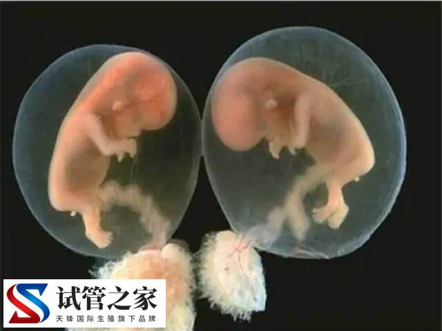 试管婴儿双胞胎的几率比自然受孕高,能达到20%了吗?(图2) 试管婴儿双胞胎的几率比自然受孕高,能达到20%了吗?(图2)