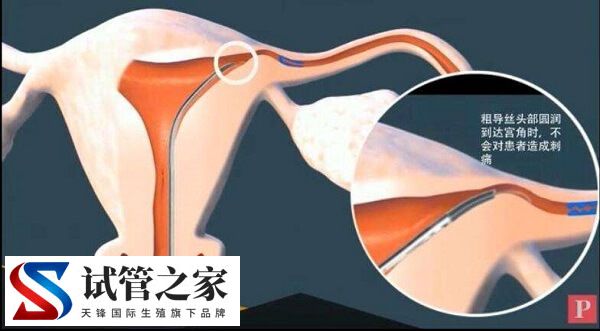 做了输卵管疏通6个月了为什么还是怀不了孕?(图1) 做了输卵管疏通6个月了为什么还是怀不了孕?(图1)