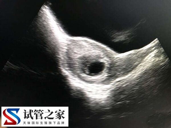 试管为什么胎停率那么高(图1) 试管为什么胎停率那么高(图1)
