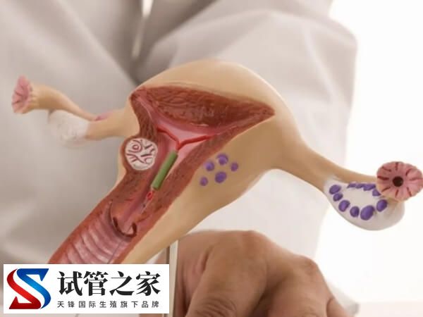 盆腔结核做试管能否成功(图1) 盆腔结核做试管能否成功(图1)