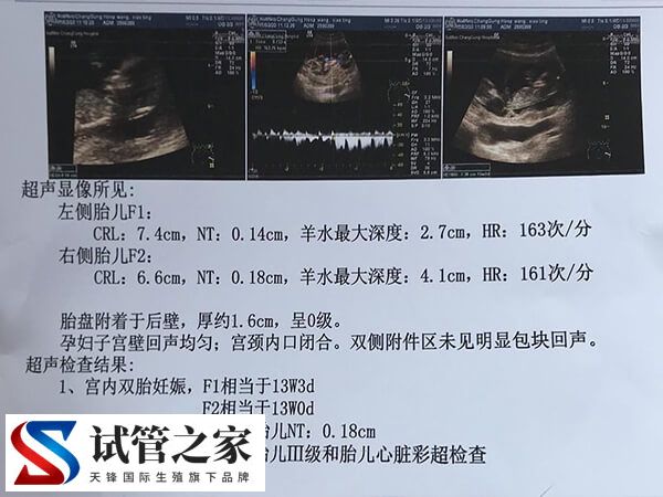 移植21天为什么要做B超(图2) 移植21天为什么要做B超(图1)