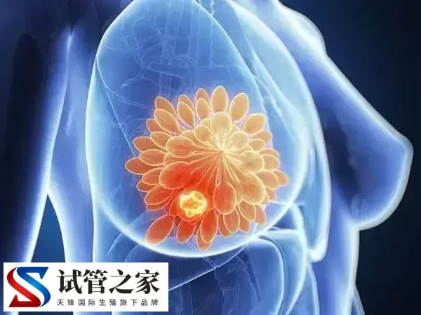 乳腺低回声影不影响试管(图1) 乳腺低回声影不影响试管(图1)