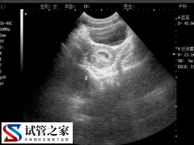 乳腺低回声影不影响试管(图2) 乳腺低回声影不影响试管(图2)