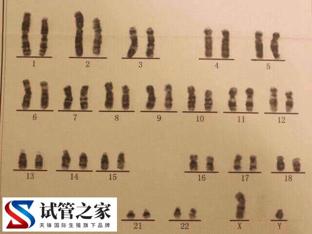 5号染色体三体是什么意思(图1) 5号染色体三体是什么意思(图1)
