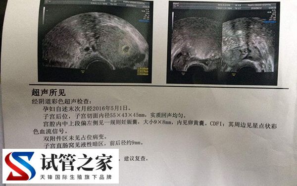 女性长期月经不调在备孕前要做什么身体检查呢?(图2) 女性长期月经不调在备孕前要做什么身体检查呢?(图2)