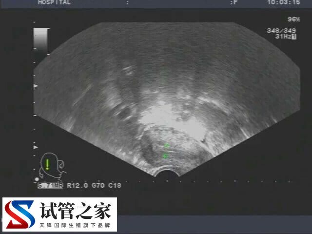 宫颈肥大做试管婴儿会不会影响着床(图1) 宫颈肥大做试管婴儿会不会影响着床(图1)