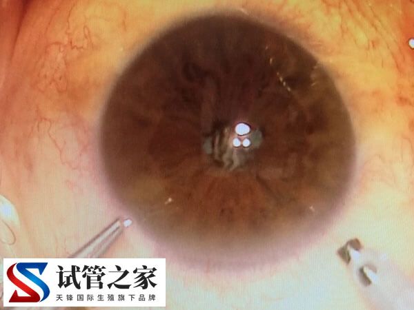 角膜营养不良有无必要做三代试管避免遗传(图1) 角膜营养不良有无必要做三代试管避免遗传(图1)