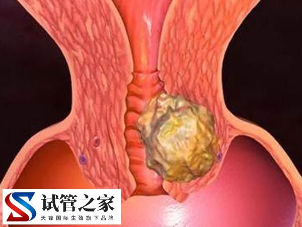 内膜癌逆转后对试管有没有影响(图1) 内膜癌逆转后对试管有没有影响(图1)