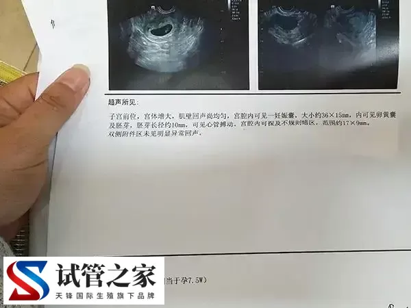 脑供血不足做试管有没有影响(图1) 脑供血不足做试管有没有影响(图1)