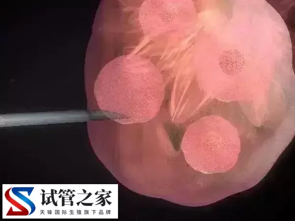 做试管婴儿过程中会不会很疼(图1) 做试管婴儿过程中会不会很疼(图1)