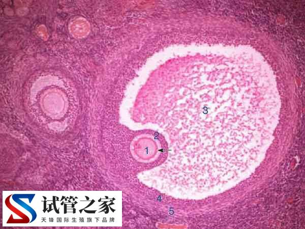 试管婴儿出现多精入卵怎么办(图2) 试管婴儿出现多精入卵怎么办(图2)