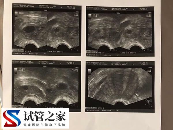 试管短方案取卵只取到一个怎么回事(图3) 试管短方案取卵只取到一个怎么回事(图3)