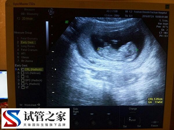 孕早期阴道B超有没有必要做(图3) 孕早期阴道B超有没有必要做(图2)