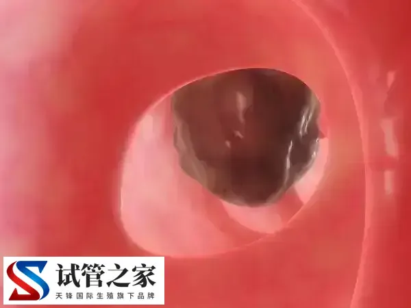 子宫内膜异位能不能做试管(图1)