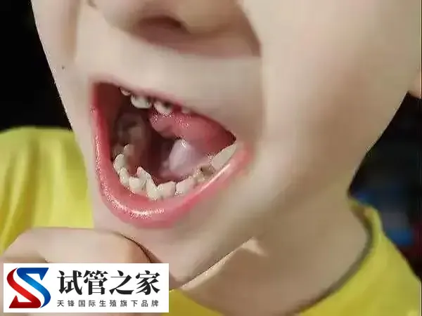 宝宝出牙晚是什么原因导致的(图1)