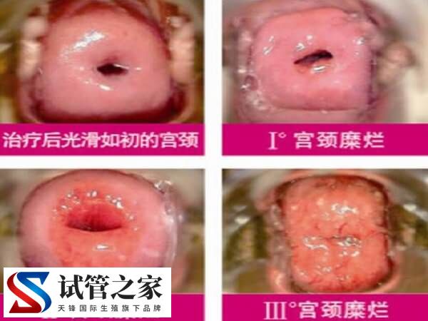 宫颈糜烂一二三度图片什么样