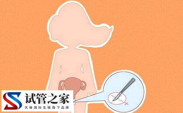 始基子宫怎么治疗(图4) 始基子宫怎么治疗(图4)